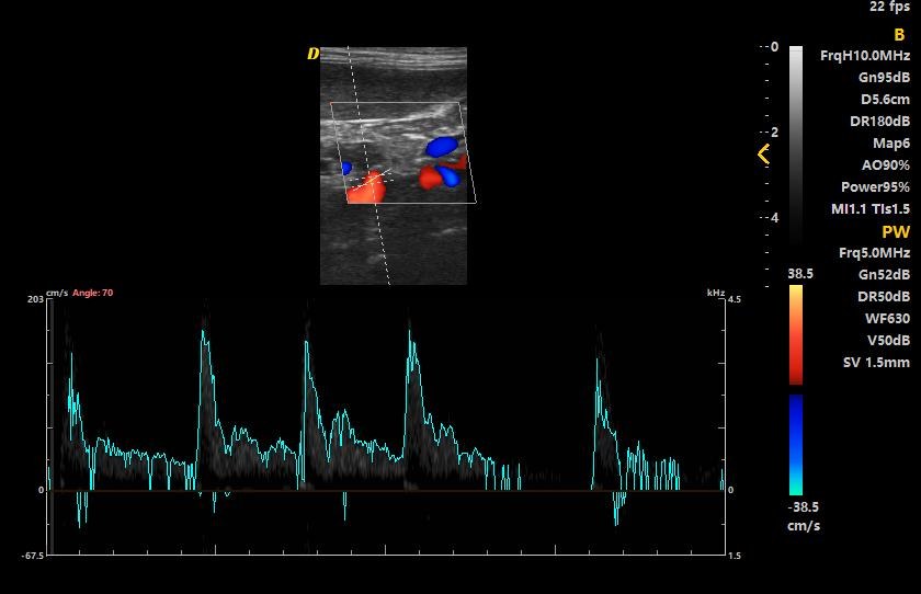 Doppler pulsato sull'aorta: il volume campione è posizionato nel vaso e lo spettro in basso mostra la velocità nel tempo