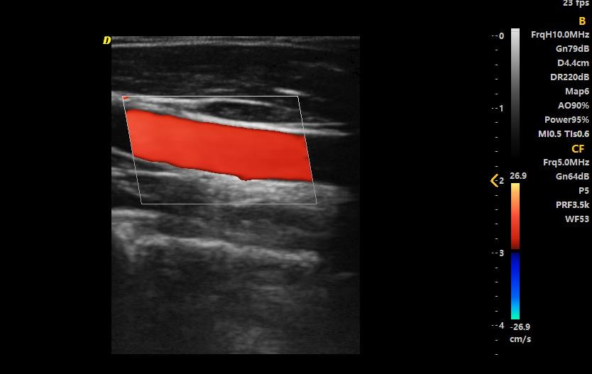 Color doppler su un vaso con sonda lineare da 10 MHz: il rosso indica flusso verso la sonda, il blu flusso che si allontana
