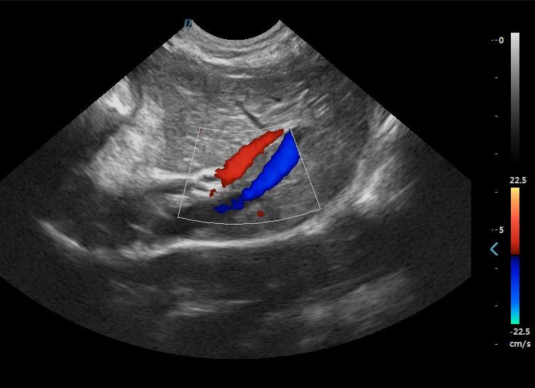 Vaso renale con color doppler in armonica: contorni netti e meno rumore nel campo vicino